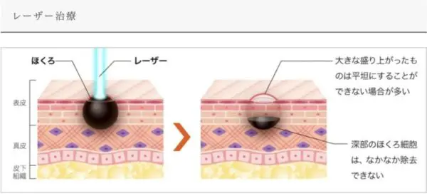 レーザーによる施術