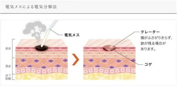 電気メスによる施術