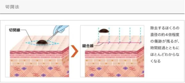 切開法による施術