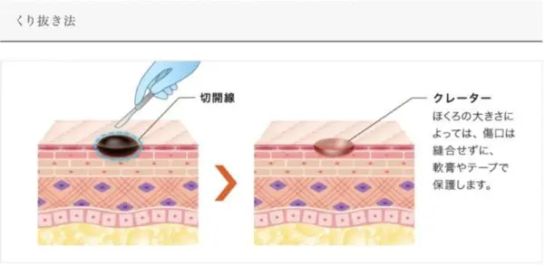 くり抜き法