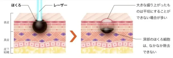 炭酸ガスレーザー