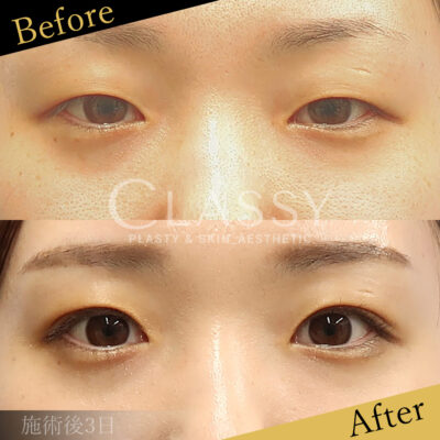 CLASSY 仙台美容外科・美容皮膚科 症例写真