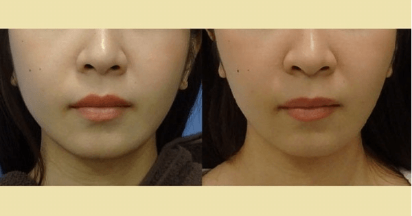CLASSY仙台美容外科・美容皮膚科-症例写真