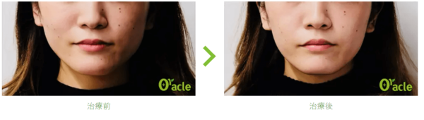 オラクル美容皮膚科の症例写真